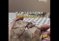 男子术后晒颅骨碎片:最薄处像指甲