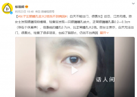 女子左眼瞳孔变大2倍找不到病因 白天无法出门很畏光