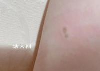多人称被苹果充电头电伤 引发了网友的关注和讨论