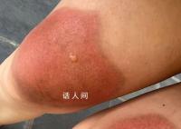 女子云南穿破洞裤7小时腿被晒伤 经医生诊断为二级烫伤