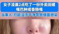 女生半夜嗦田螺肿成香肠嘴 当时以为是辣的