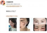 我的脸被隐翅虫毁容了 不少网友晒出同款伤疤