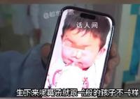 3岁男孩患象鼻病全球仅34例 且只在非洲国家发现