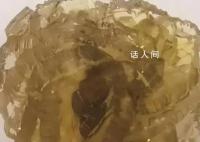台州女子身体里取出了“花” 晶莹剔透酷似钻石形如玫瑰