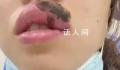 女子睡觉被蜈蚣咬醒 嘴肿成“香肠”