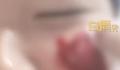 男生挤痘流血近1小时:用了400张纸