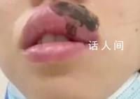 女子睡觉被蜈蚣咬醒 嘴肿成“香肠”