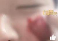 男生挤痘流血近1小时:用了400张纸