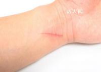 9岁女孩被猫抓伤高烧14天 四肢冰凉且头痛精神不佳