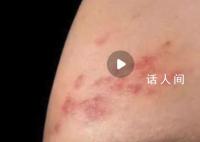 新冠后得带状疱疹的人变多了?将带状疱疹纳入诊断体系