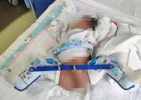 家属称剖宫产时孩子大腿被掰骨折 却不告知家属