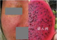 杭州女子养仓鼠脸烂成火龙果 整张脸红得发紫