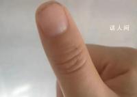 荔枝季致广东人拇指成黑色 广东人又实现了荔枝自由