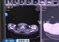 36岁男子吹空调住进ICU 如何预防空调病