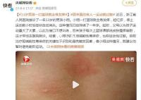 13岁男孩一打篮球就全身发痒 停止运动数小时后症状自动消失
