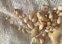 拔掉57颗牙是什么体验 引发热议