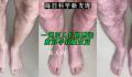 一英国人长期感染新冠导致腿变蓝 坐下后2分钟就恢复了