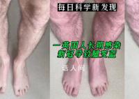一英国人长期感染新冠导致腿变蓝 坐下后2分钟就恢复了
