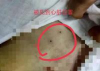 医院回应穿刺失误致女童死亡 正在走司法途径