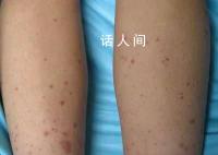 女子称熬夜致免疫力低下确诊紫癜 好在发现及时对身体没有造成太大损伤