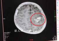 医生7小时取出小伙脑内10cm成虫 目前患者已经可以下床行走