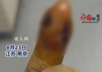 女子拔倒刺致骨髓炎要刮骨手术 处理不当会有截肢风险