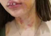 23岁女子自曝遭夫妻两人殴打扒衣 自贡警方介入调查