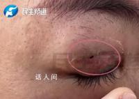 女子修复双眼皮后竟然多个洞 网友：太吓人了