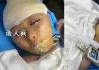打破学生头骨老师停职接受公安调查 有关部门将依法依规严肃处理涉事人员