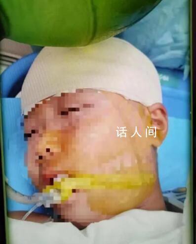 被打破头骨女生已清醒?家属回应