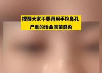 女生称因爱抠鼻子致鼻内长多团真菌 目前手术后从蝶窦里取出10多个真菌团