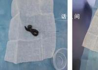 女子咳嗽半月 气管发现8cm蚂蟥