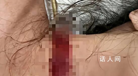 女子称孕期遭家暴被丈夫拿刀割脖子 妇联表示已介入调查