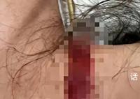 女子称孕期遭家暴被丈夫拿刀割脖子 妇联表示已介入调查