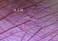女孩外地求医 切开阑尾有虫子游出