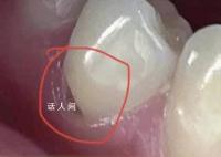 27岁女子长期横向刷牙致牙齿缺损 什么是横向刷牙的危害