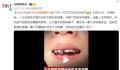 女子平躺玩手机 被砸断半颗门牙