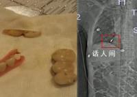 老人术后体内发现5颗牙和牙套 这样的离奇情况你听说吗