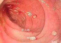 14岁男孩肠道里查出20多颗“珍珠” 爸爸爷爷均因此去世