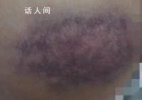 官方调查学生屁股被老师打成黑紫色 引发家长的不满