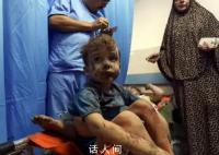 加沙孕妇在无麻醉下接受剖腹产 我们极度缺乏供应