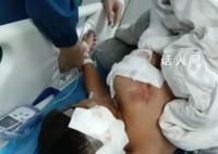 咬伤10岁男童的阿拉斯加犬已被打死 男童仍在湖南省儿童医院ICU病房内抢救