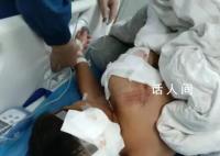 男童遭阿拉斯加犬咬伤 仍在ICU救治