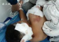 被狗咬伤男童已出ICU:耳朵缺一块