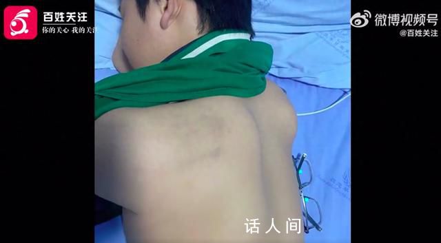 家长称13岁儿子被纪律委员打骨折 身体多处软组织损伤