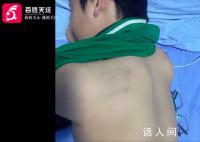 家长称13岁儿子被纪律委员打骨折 身体多处软组织损伤