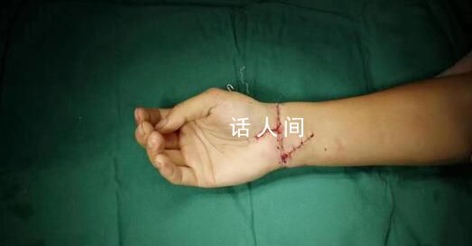 29岁小伙手腕被切断医生通宵缝合 通宵手术只为保住小伙右手