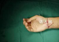 29岁小伙手腕被切断医生通宵缝合 通宵手术只为保住小伙右手