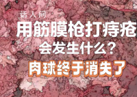 筋膜枪可以治痔疮?可能造成血管破裂