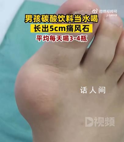 男孩1天4瓶饮料长5厘米痛风石  脚趾关节处已经堆积大量的痛风石